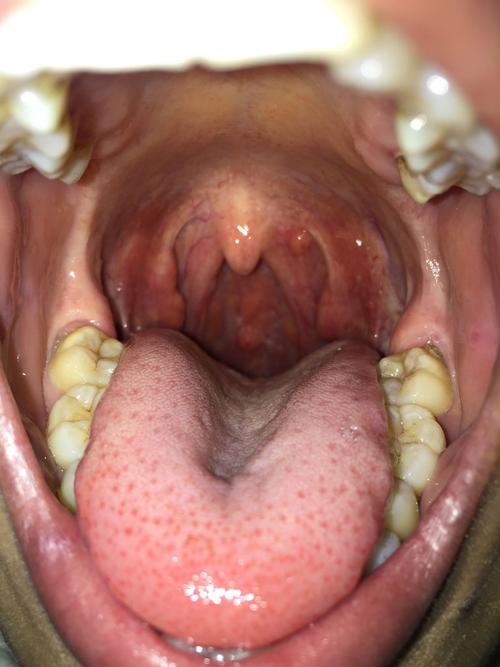 喉咙有异物感怎么办