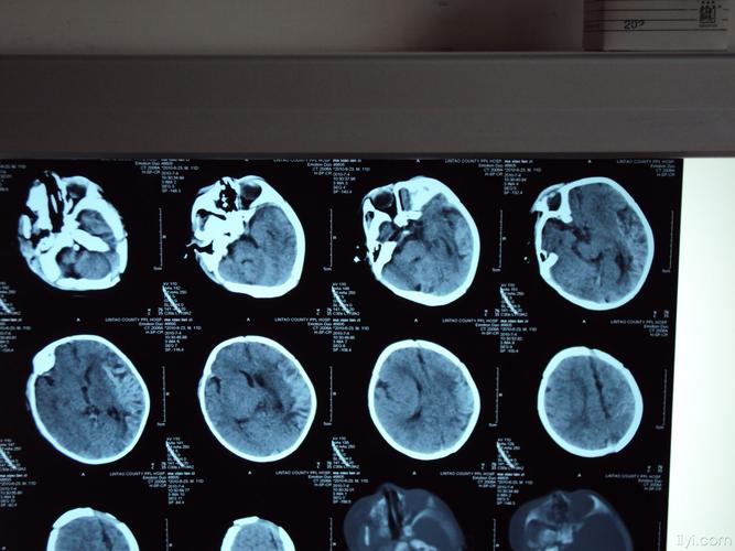 脑CT对宝宝有危害吗？