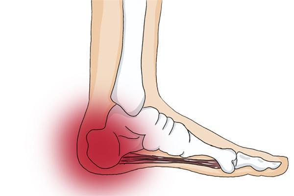 足部关节损伤有哪些危害？