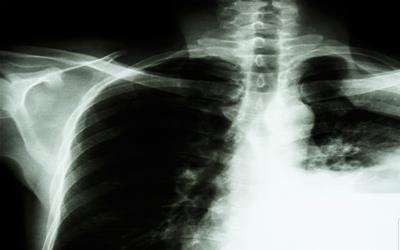 肺实变是什么意思