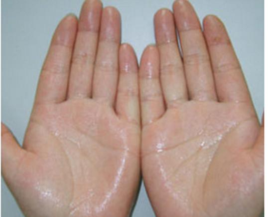 你的手为什么出很多汗？