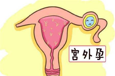 宫外孕最常见的早期症状