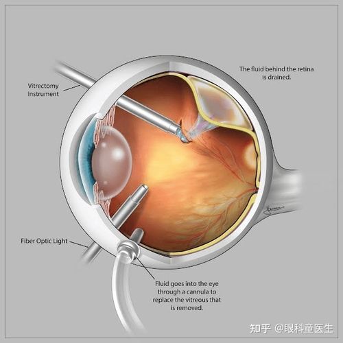  手术会引起视网膜脱离 